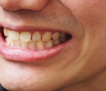 Teeth-Discoloration-and-Stains
